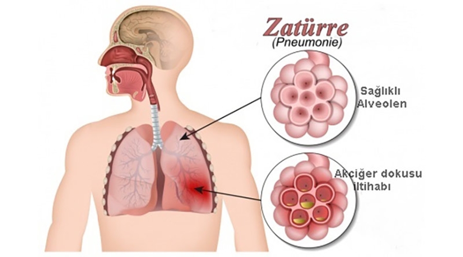 zaturre-olumle-sonuclanan-besinci-hastalik-2.jpg